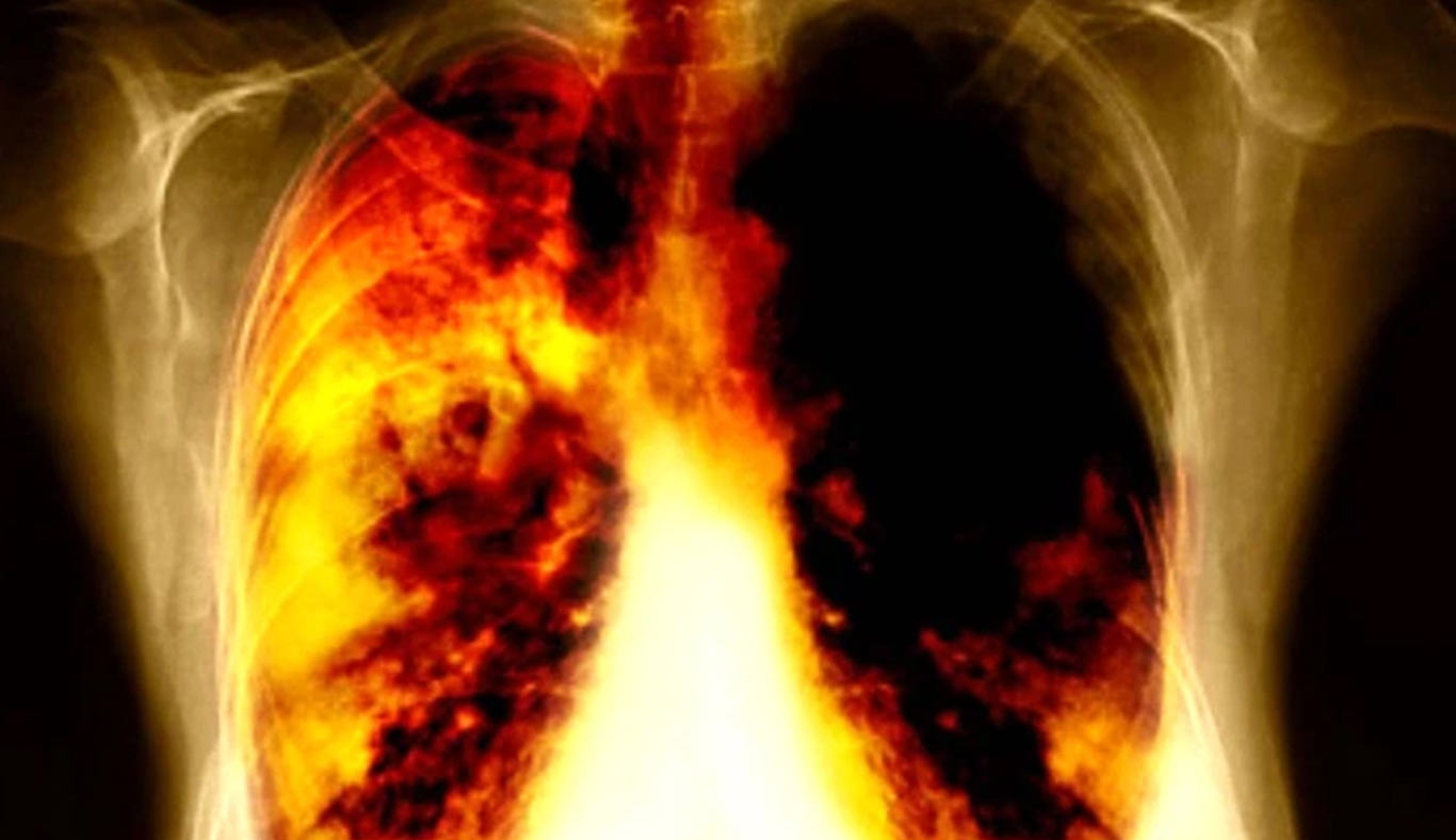 Radiografía cáncer de pulmón 