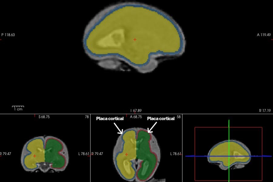 Resonancia de la placa cortical