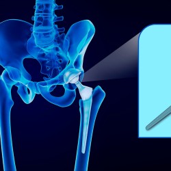 3D Technology! Augmented reality to improve pelvic surgery
